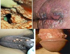 Illustration for article titled Di Sekitar Penis Tumbuh Kutil ? Obatnya Apa ?